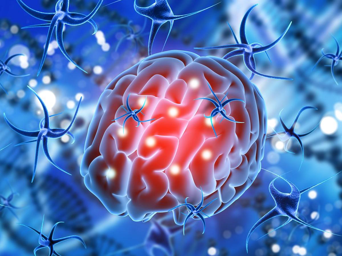 Glioma: qué es, a quiénes afecta y opciones de tratamiento disponibles