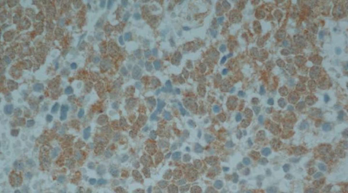 Investigadores argentinos logran avances en la terapia para neuroblastoma infantil (Crédito: CONICET)