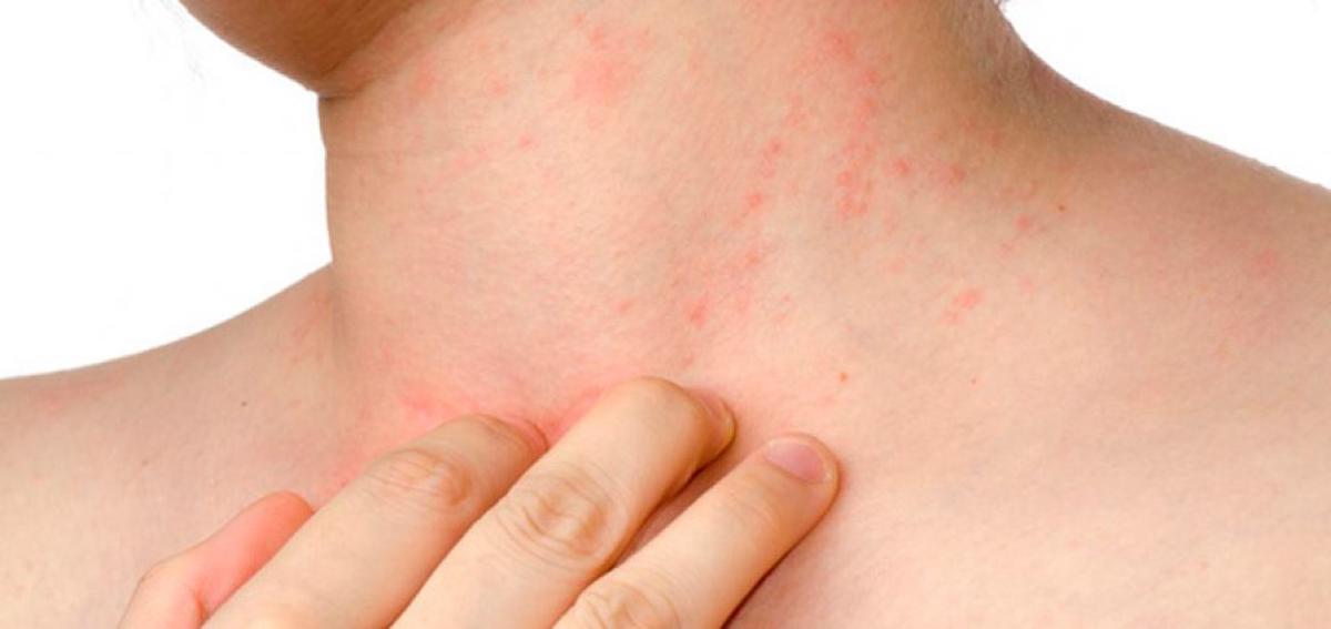 La dermatitis atópica en la infancia puede ser un indicador de asma y alergias futuras