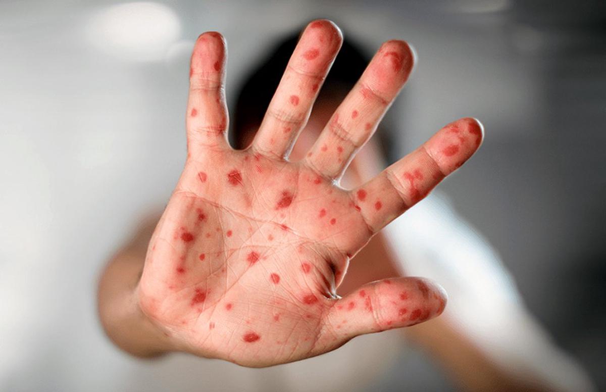 Se reportan 4 nuevos casos de Mpox en Argentina y el total asciende a 15 en 2026