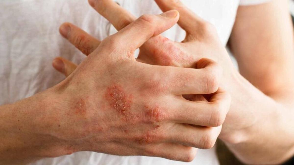 ANMAT autoriza una nueva terapia oral para tratar la artritis psoriásica en adultos