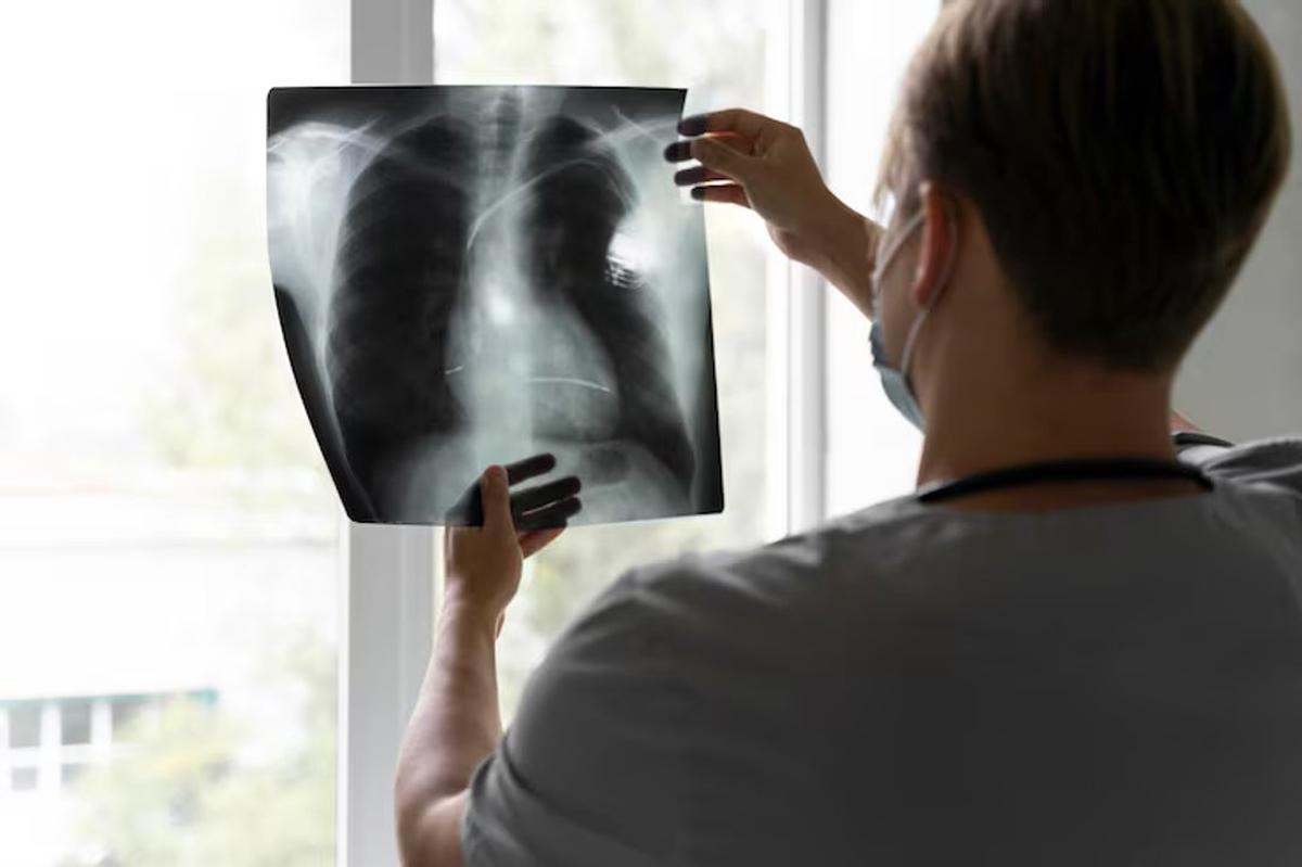 Derrame pleural: causas, síntomas y diagnóstico de esta afección respiratoria