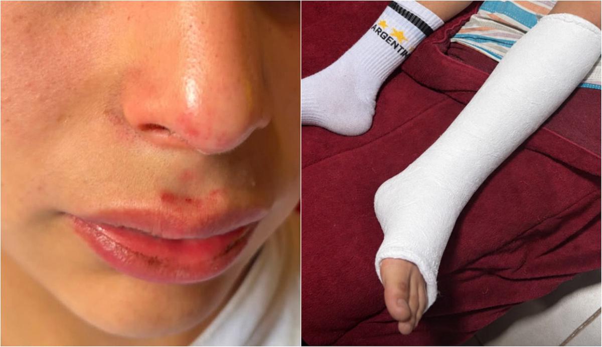 Denuncian que un policía golpeó a dos adolescentes en Alta Gracia: uno sufrió una fractura.
