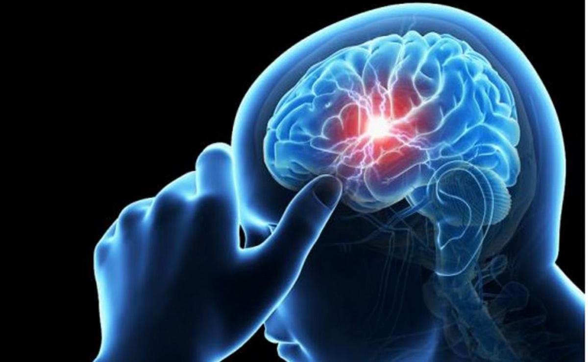 FOTO: El 29 de octubre se celebra el Día Mundial del Accidente Cerebrovascular (ACV).