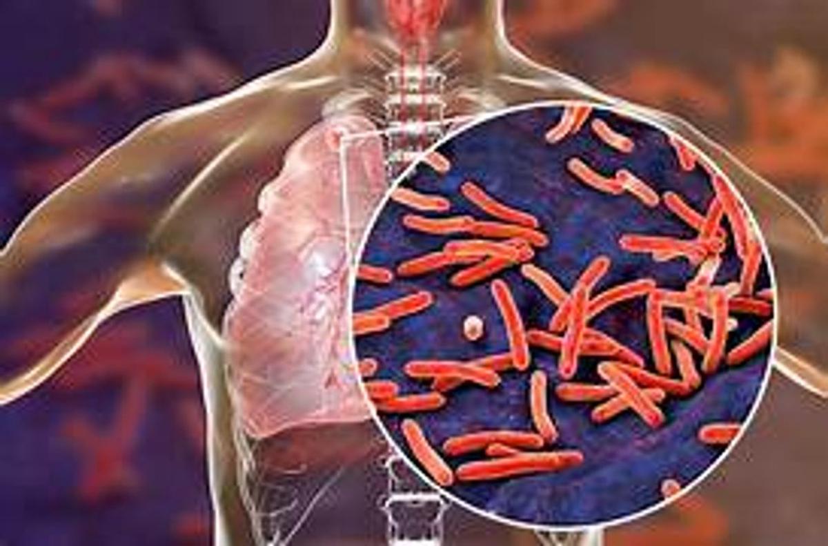 Aumento alarmante de casos de tuberculosis en Argentina: 6.482 reportados
