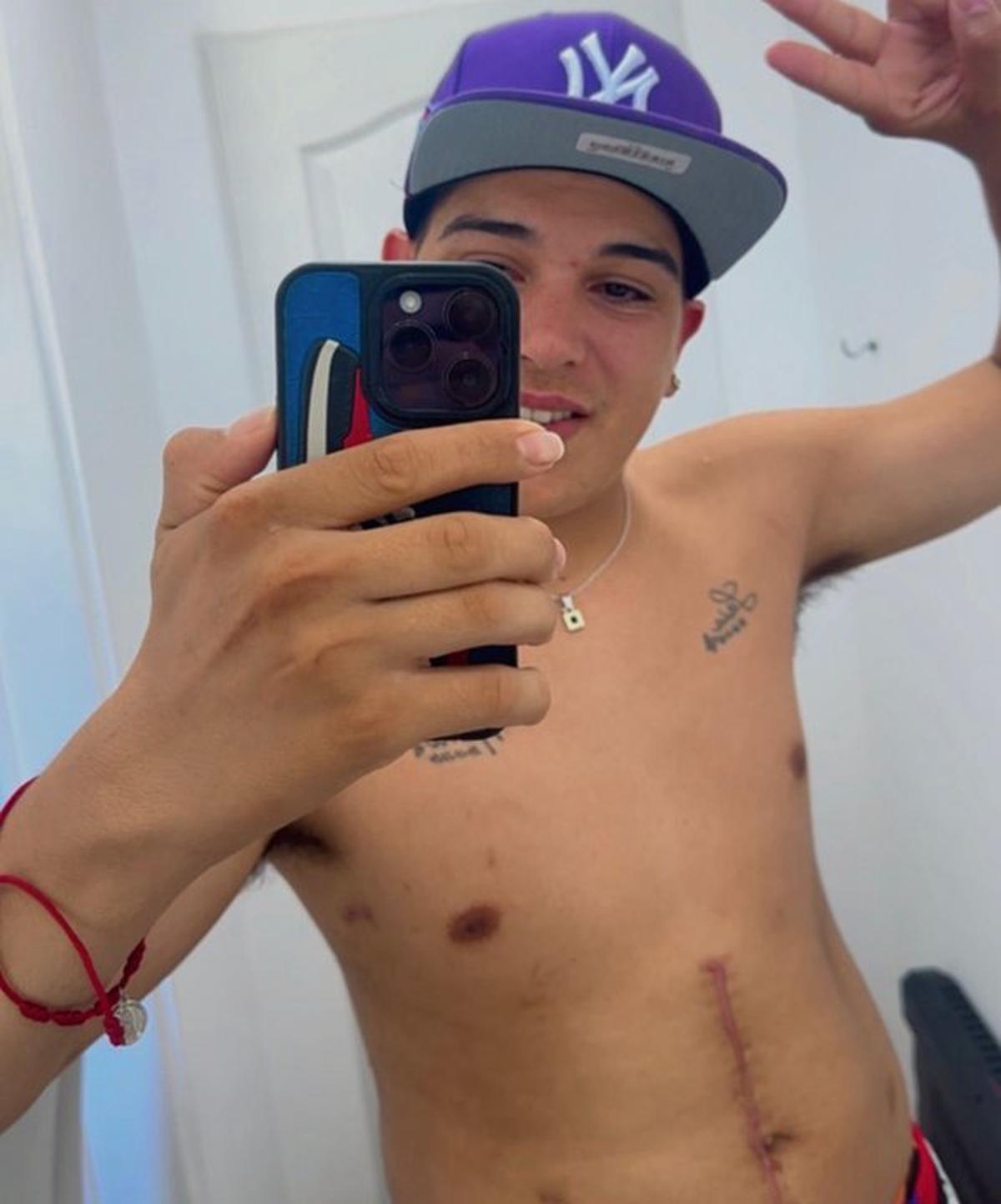 Thiago Medina mostró por primera vez sus cicatrices en redes sociales.