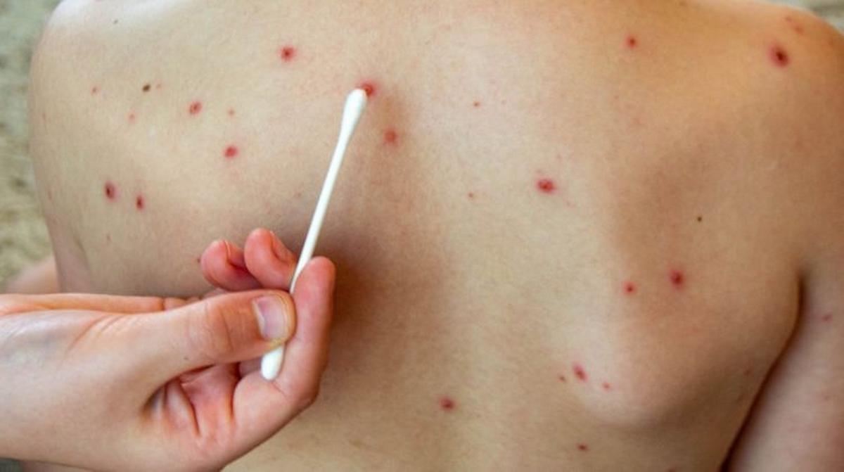Aumentan los casos de sarampión en el país.