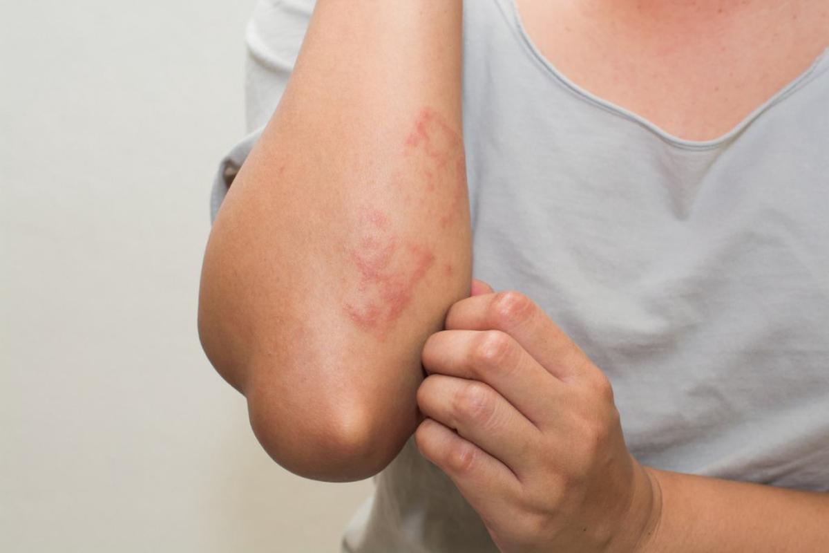 Dermatitis atópica: desafíos en el tratamiento y su impacto en la calidad de vida