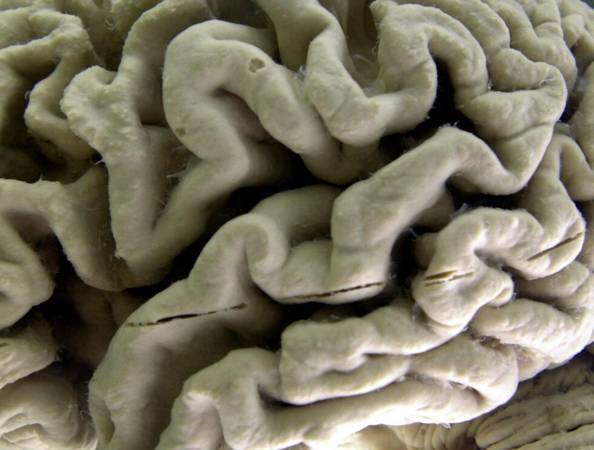 Un análisis de sangre ayuda a detectar un alto riesgo de Alzheimer en pacientes sanos