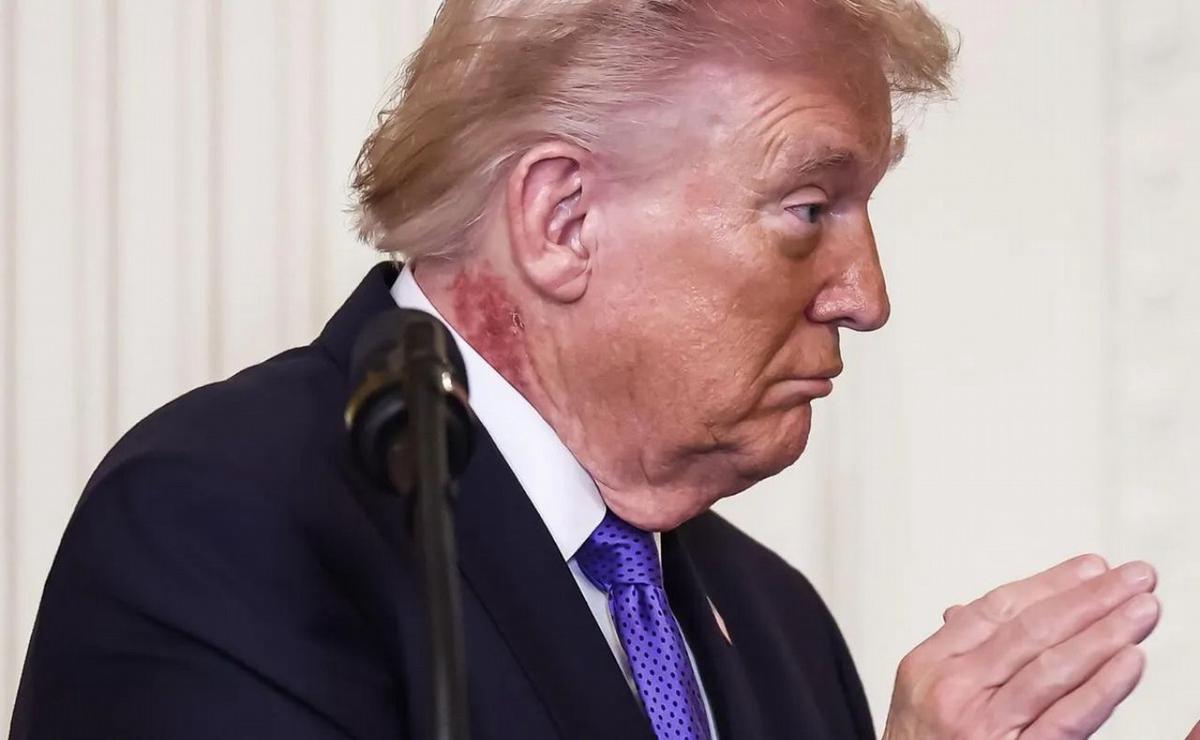 Las manchas cutáneas de Donald Trump.