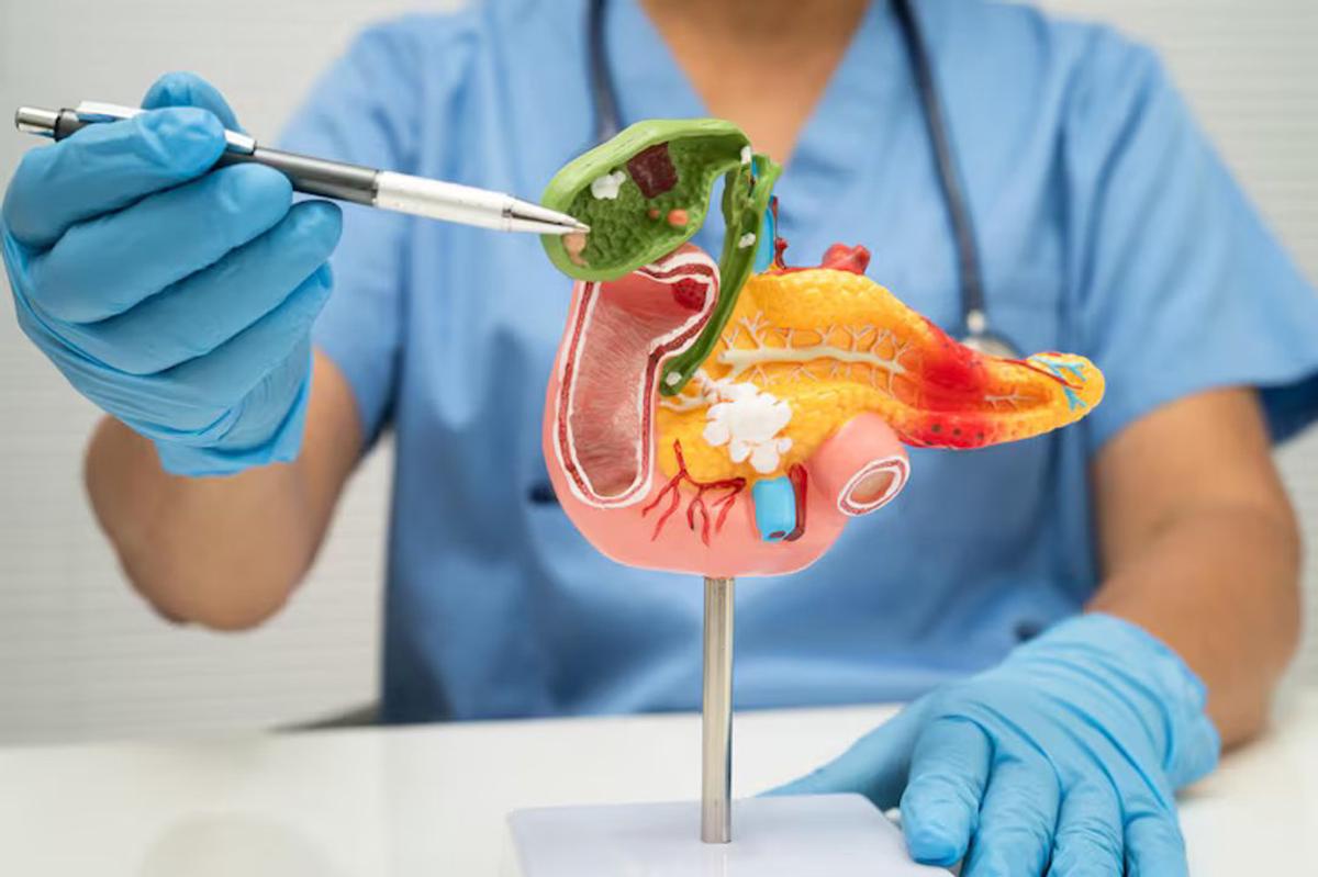 Avances en el tratamiento del cáncer de páncreas: una nueva terapia duplica la supervivencia